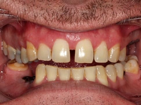 implante dental antes 2