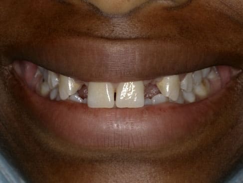implante dental antes 3