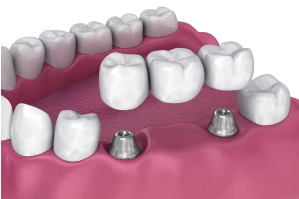 Puente dental