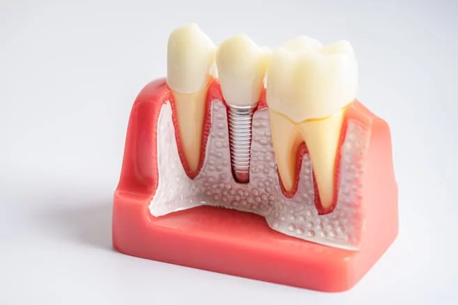 Implantes dentales Zaragoza - Clínica Implantarex