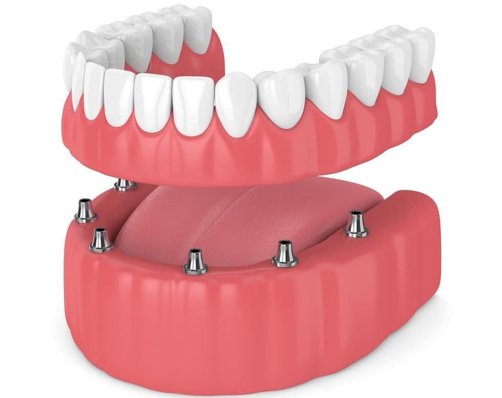 complete dental prosthesis Huesca