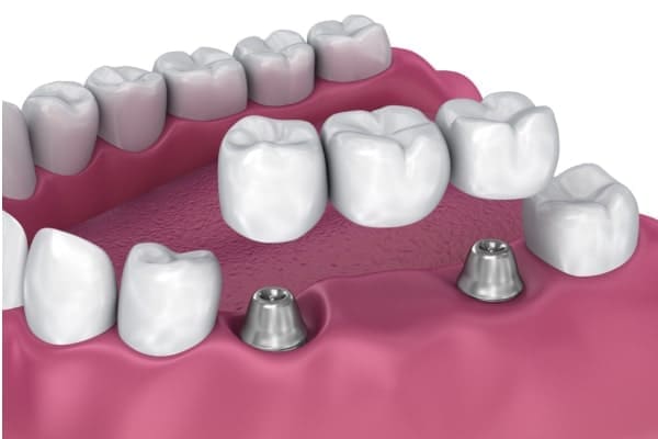 protesis puente dental Palencia