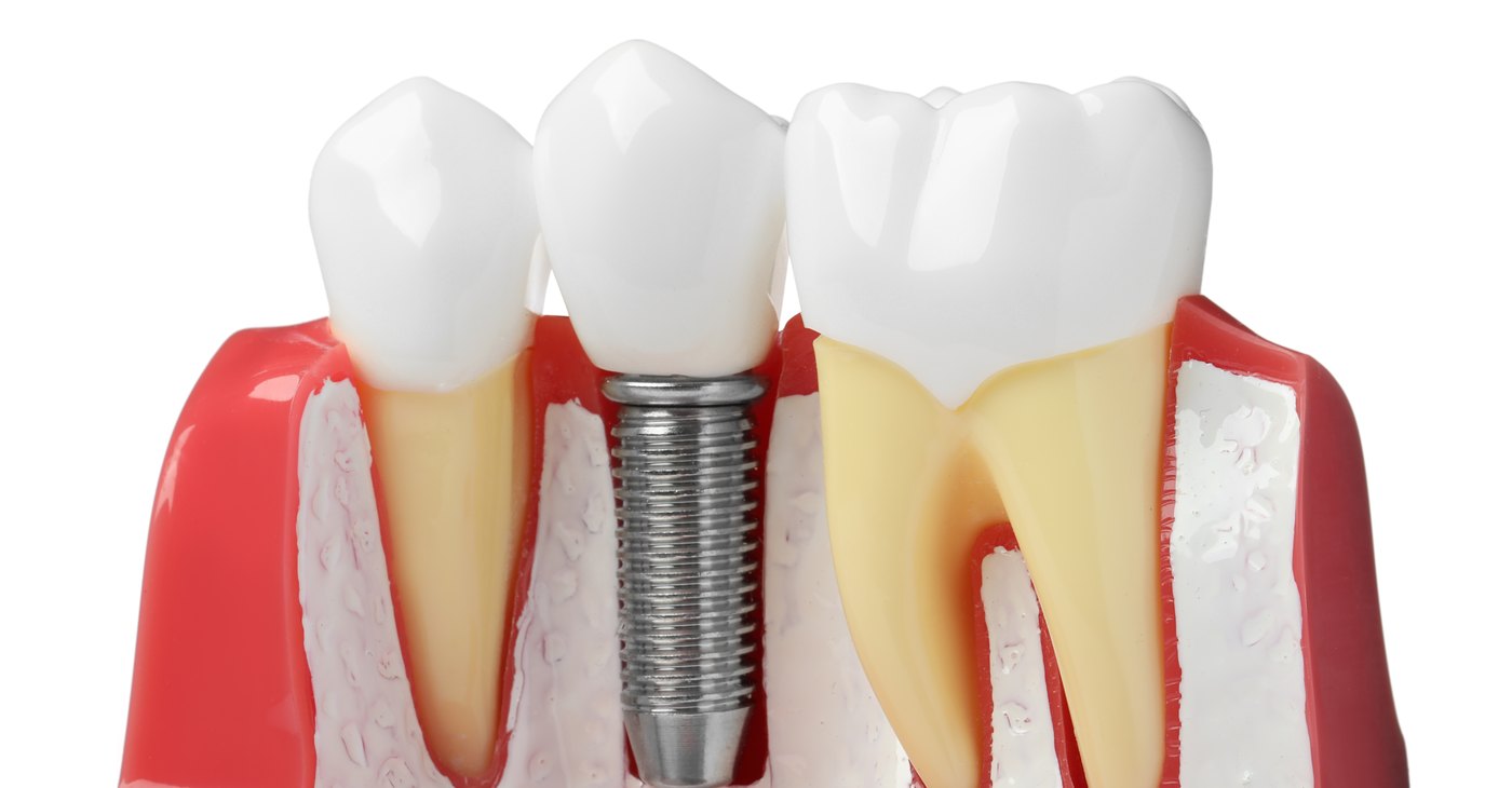 Modelo de encía con un implante dental de titanio entre dos dientes naturales
