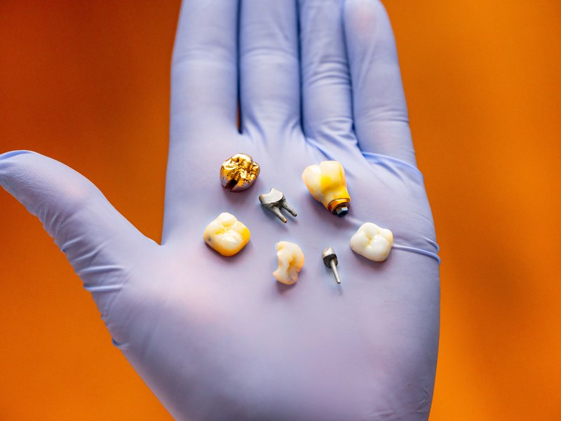 Mano con guante que sostiene varias coronas dentales y piezas metálicas de implante