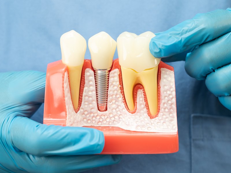 Maqueta de un implante con su corona entre dos dientes naturales, sostenida con guantes