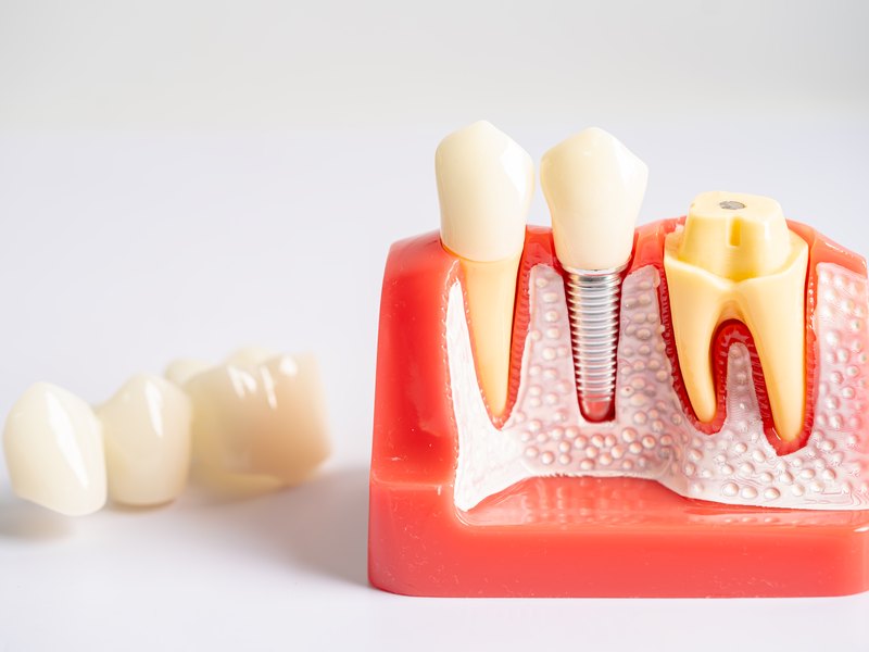 Maqueta dental con un implante y su corona junto a dos dientes, y coronas sueltas al lado
