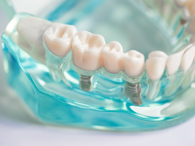 Maqueta transparente de una mandíbula con un puente de tres piezas sujeto por dos implantes