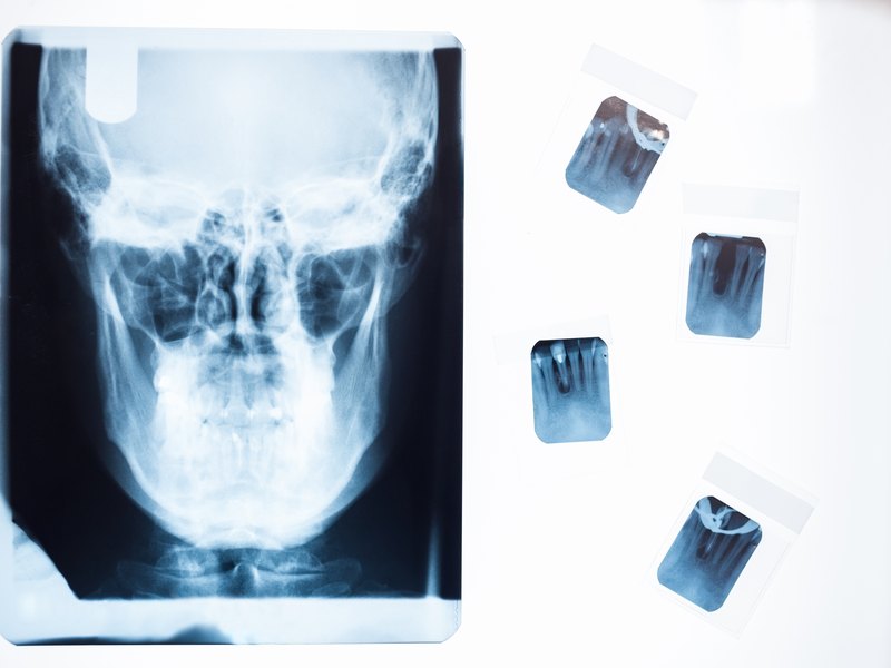 Radiografía frontal del cráneo y radiografías dentales pequeñas sobre una mesa de luz